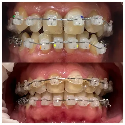 Как брекеты меняют лицо – Стоматология Созидание