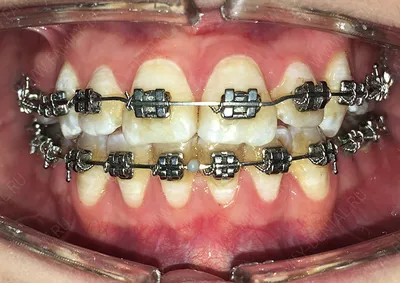 Как брекеты меняют лицо - Cтоматология Май
