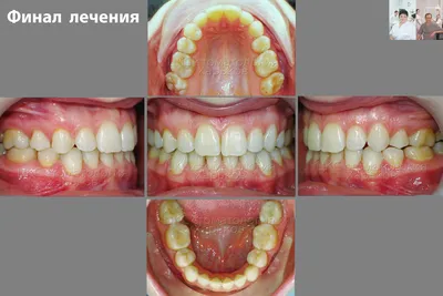 Брекет-система - шаг к красивой улыбке - интересно об ортодонтии,  имплантации и протезировании зубов