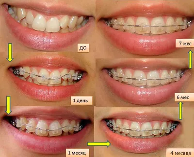 Как меняется лицо после брекетов и элайнеров - клиника Ортодонтика, Москва