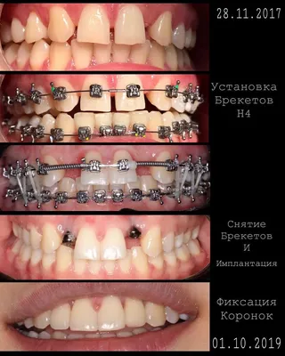 Фото до и после стоматологии | Клиника Damas Clinic