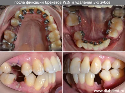 Установка керамических и металлических брекетов под ключ недорого