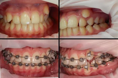 Брекеты H4 - Семейная стоматология \"Новый стандарт 32\"