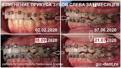 Брекеты для детей h4 в 12 лет позволяют не стесняться своей улыбки –  Немецкий Имплантологический Центр, Москва