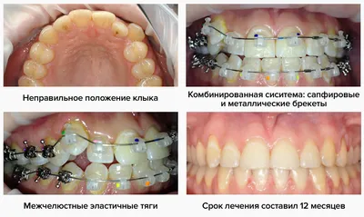 Виды брекетов – плюсы и минусы | «OrthoLike»