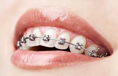 Инновационные брекеты H4 (OC Orthodontics — США)