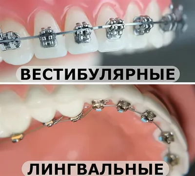 Самолигирующие брекеты - что нужно знать?