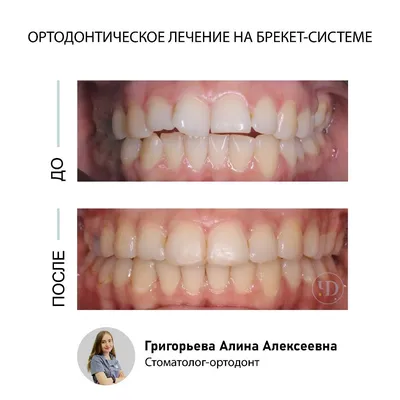 Брекеты в Курске: установка брекетов в стоматологии Doctor Smile