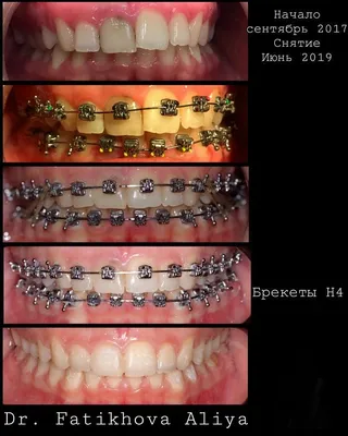 Брекеты H4 в Казани с установкой под ключ - Мой Ортодонт