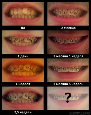 Материалы с меткой \"3 месяца\" (стр. 2) | Брекет.Info