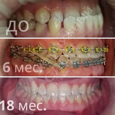 Сколько носят брекеты на зубах: минимальный срок для взрослых и детей,  влияющие факторы