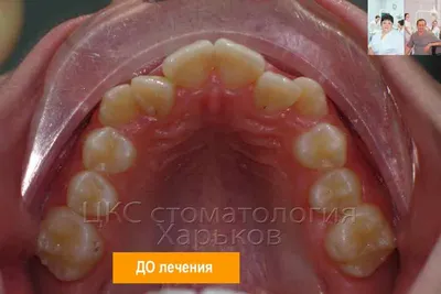 Лечение брекетами — цена, сроки и результаты | Damas Medical Center