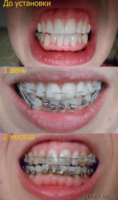 Установка брекетов на зубы в Санкт-Петербурге. Цена и стоимость установки  под ключ
