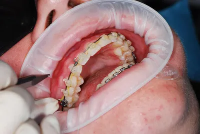 О стоматологии и не только...: Лечение брекетами. Жалко удалять зубы!