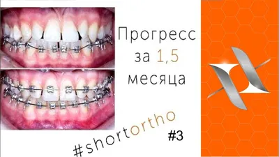 Что сделали брекеты за 1,5 месяца? #Shortortho (Выпуск №3) - YouTube