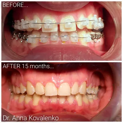 Результаты ортодонтического лечения. До и после лечения.