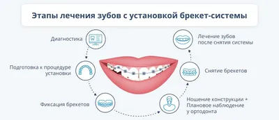 Брекеты - стоимость услуги Ортодонтия — выравнивание зубов в Киеве, Брекеты  - цена в стоматологии lipinskii.com.ua