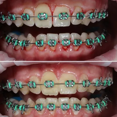 Динамика выравнивания зубов за 4 месяца