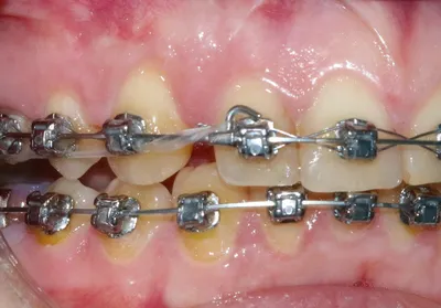 Установка брекетов | DentalKnysh Стоматология во Львове