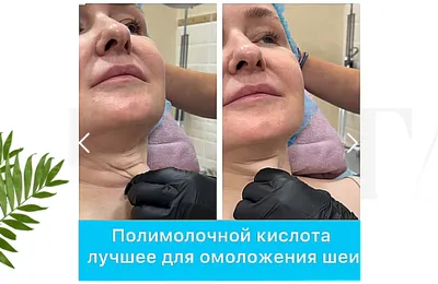 Увеличение губ: опыт редакции - BeautyHunter.ru