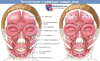 Брови до и после ботокса - 76 фото