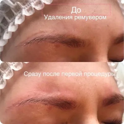 Удаление татуажа