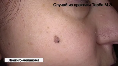 Пузырек на коже — 2 ответов | форум Babyblog