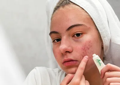 Лечение проблемной кожи лица в Одессе - клиника Доктора Лилианы