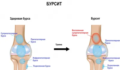 Kinesiotherapist Dubai 🇦🇪 on Instagram: \"☘☘☘Синдром \"гусиной лапки\" или  бурсит \"гусиной лапки \" - это воспалительное заболевание сумки  объединённого сухожилия тонкой, портняжной и полусухожильной мышц. ☘«Гусиная  лапка» — это место прикрепления ...