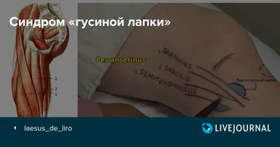 Kinesiotherapist Dubai 🇦🇪 on Instagram: \"☘☘☘Синдром \"гусиной лапки\" или  бурсит \"гусиной лапки \" - это воспалительное заболевание сумки  объединённого сухожилия тонкой, портняжной и полусухожильной мышц. ☘«Гусиная  лапка» — это место прикрепления ...