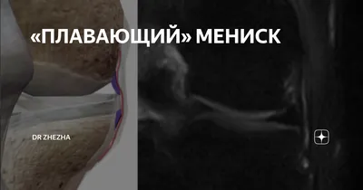 Артроз коленного сустава: причины, симптомы, виды, стадии, лечение без  операции в Москве