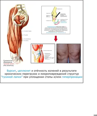 Синдром синовиальной складки коленного сустава — Physiotherapist