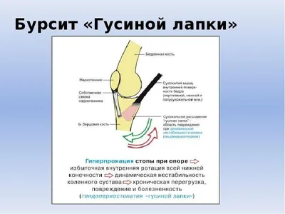 Бурсит коленного сустава – причины, симптомы, диагностика и лечение в  клинике «Будь Здоров»