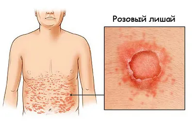 Лишай — что это, причины, симптомы, лечение | Блог | Complimed