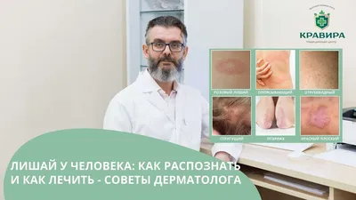 Лечение отрубевидного лишая ⚕️ Клиника \"Элласес\" ☎ 097-970-70-90  Дерматология Гинекология Урология