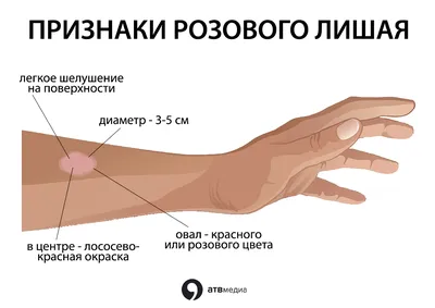 Мази от розового лишая: эффективные и проверенные средства