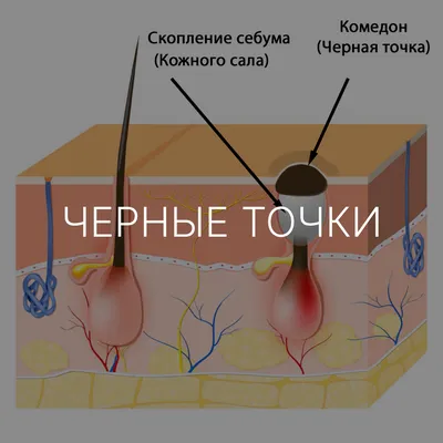 Маска от черных точек: как выбрать и как применять в домашних условиях