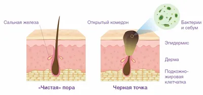 Чёрная точка на коже | ШугарБояр | Дзен