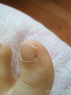 Черная точка на ногте большого пальца ноги фото фото