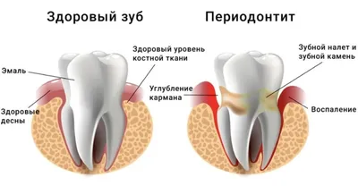 Перикоронит зуба мудрости: симптомы заболевания, лечение воспаления  капюшона десны, удаление