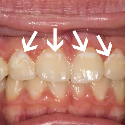 Белые пятна на зубах | возможные причины появления у взрослых - лечение и  профилактика