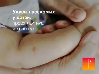 Укусы насекомых у детей: профилактика и лечение | Клиника Рассвет