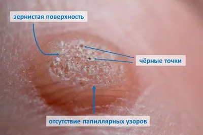 Томский областной онкологический диспансер - Меланома