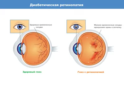 Как лечить черные точки в глазах | МедЛайф | Дзен