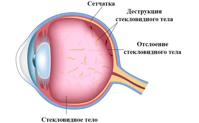 Лопнули сосуды в глазу - причины и лечение