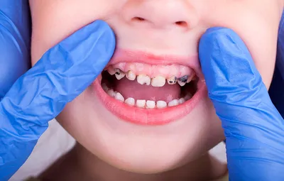 Черные зубы у детей фото фото