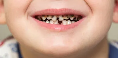 Черные зубы или «Налет Пристли» 🥸 Заметили у своего ребенка почерневшие  молочные зубы? И так, Налет Пристли, откуда же он берется: Все… | Instagram
