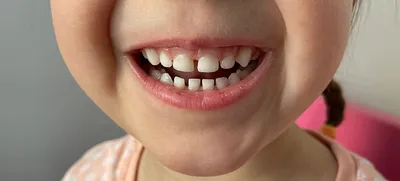 У ребёнка почернели зубы: в чём причина и что теперь делать | Мел