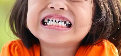 У ребенка черные зубы | О жизни и тайне | Дзен