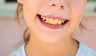 Что делать, если у ребенка чернеют зубы | TopDent | Дзен